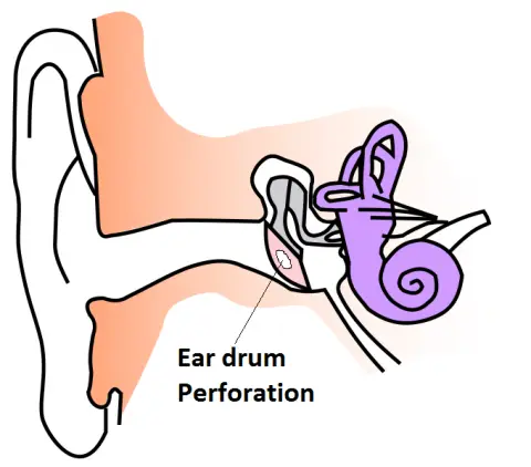 ear drum rupture