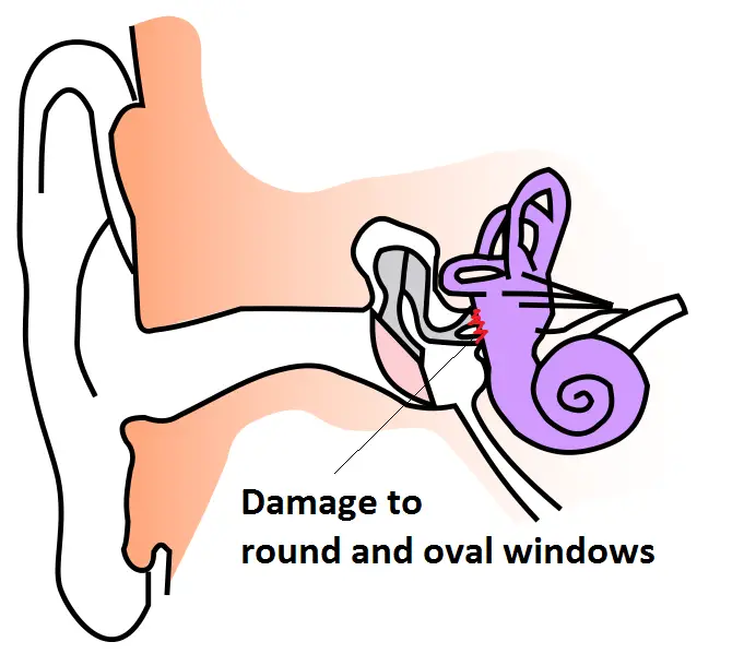 inner ear barotrauma