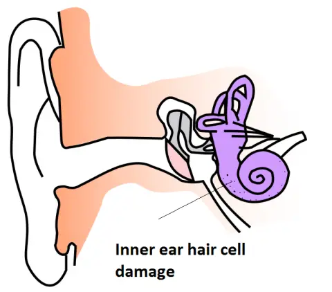 inner ear trauma