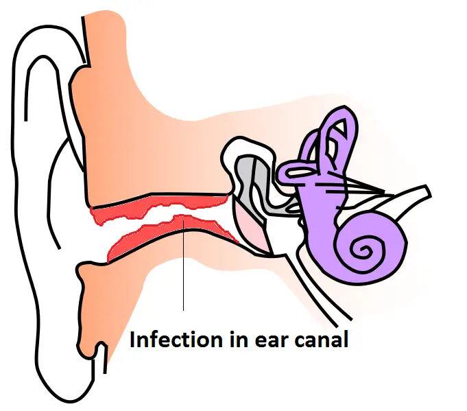 swimmer's ear infection